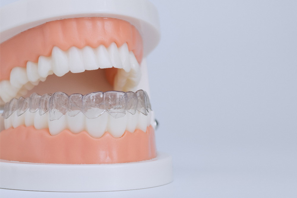 Clear braces treatment timeline and monthly progress at Birch Dental Whitby